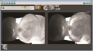 Caries Detection | Dr. Camillo L. Fontana, DMD