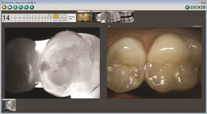 Caries Detection | Dr. Camillo L. Fontana, DMD